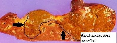Fulminan hepatit: Masif karaciğer nekrozu - Akut kar­aciğer atrofisi