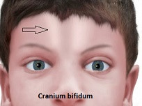 Cranium bifidum occultum