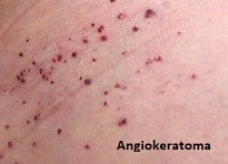 Anderson-Fabry hastalığı (Fabry sendromu; Angiokeratoma corporis diffusum)