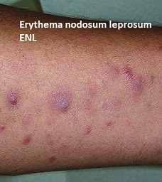 Erythema nodosum leprosum -  ENL