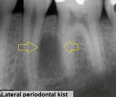Lateral periodontal kist