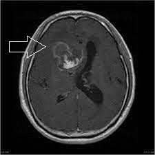 Beyin tümörleri