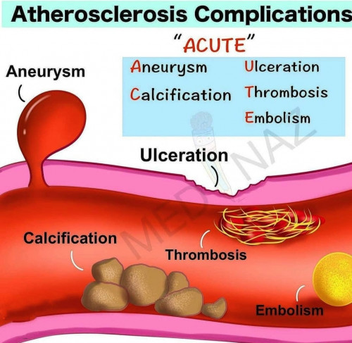 Ateroskleroz Komplikasyonları