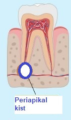 Periapikal kist - Radiküler kist - Apikal periodontal kist
