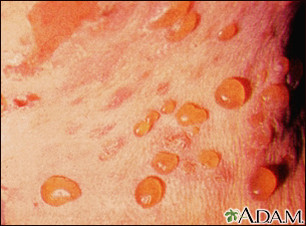 Stevens-Johnson sendromu (Erythema multiforme exudativum; Toksik epidermal nekrolizis; Flessinger-Rendu sendromu)