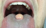 Oral-facial-digital sendrom tip III (OFD III; Sugarman sendromu)