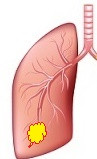 Akciğer absesi