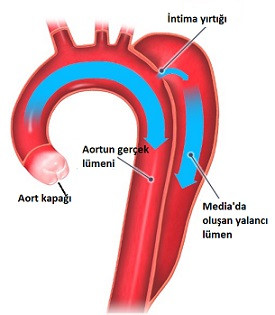 Aort Diseksiyonu