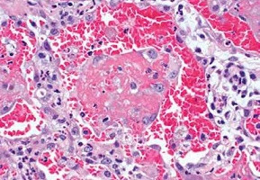 Akciğerler: İmmun sistem patolojileri kökenli fibrozis