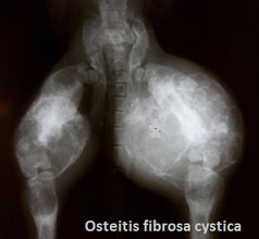 Psödohipoparatiroidizm (Albright herediter osteodistrofisi; osteitis fibrosa cystica)