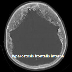 Morgagni-Stewart-Morel sendromu (hyperostosis frontalis interna)
