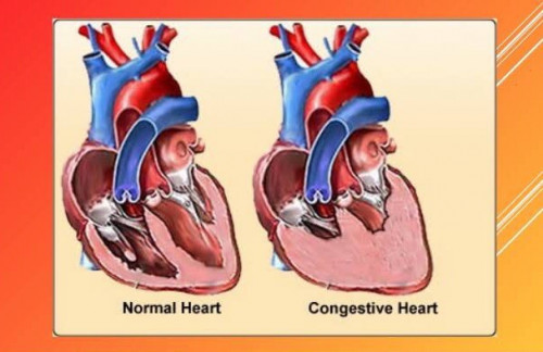 3) Konjestif Kalp Yetmezliği 