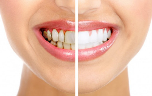 Dişlerde gelişimsel ve adaptif anomaliler 