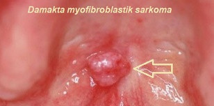 Myofibroblastik sarkoma