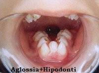 Aglossia-adactylia sendromu (hypoglossia-hypodactylia sendromu)