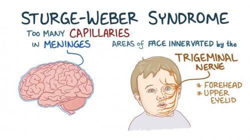 Sturge -Weber Sendromu