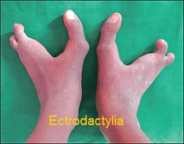 EEC1 sendromu (Ectodermal dysplasia-Ectrodactylia-Clefting1)
