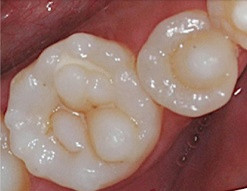 Dişlerde tüberkül malformasyonları