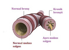 Kronik bronşit