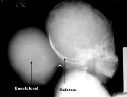 Ensefalosel - Kraniyal meningosel - Cranium bifidum - Meningoensefalosel