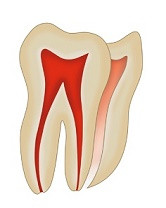 Dişler ve Füzyon