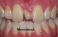 Mesiodens