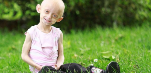  Hutchinson–Gilford progeria sendromu (HGPS) 