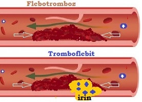 Flebotromboz - Tromboflebit