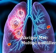 Akciğer: Metastatik tümörler