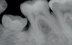 Dişlerin ankilozu sendromu