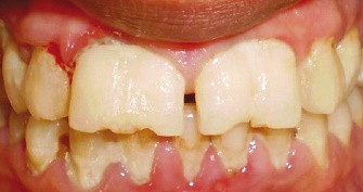Dişlerin füzyonu