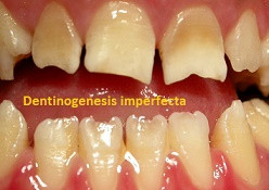 Dentinogenesis imperfecta