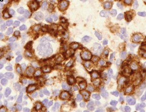 Anjiyoimmunoblastik T-hücre lenfoması * Angioimmunoblastik T-lenfosit lenfoması