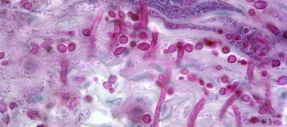 Ailesel Candidiasis