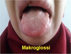 Mukopolisakkaridozis sendromları: Scheie sendromu (Mukopolisakkaridozis; I-S; MPS I-S)