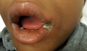 Oral mukoza: Elektrik akımı yanıkları