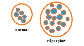 Hiperplazi