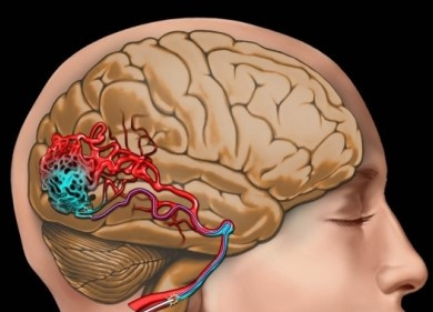 Beyin: Arteriovenöz malformasyonlar