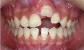 Dişlerin ankilozu sendromu