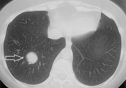 Akciğer: Benign tümörler