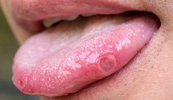 Oral ülserler - Oral erozyonlar