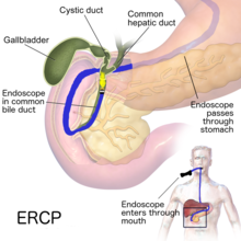ERCP(Endoskopik retrograd kolanjiyopankreatografi)