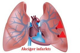 Akciğer infarktı - Pulmoner infarkt