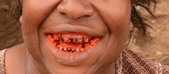Dişlerde renkleşme - Dişlerin pigmentasyonu