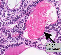 Gölge hücreli odontojen tümör