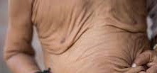 Kırışık deri sendromu (wrinkly skin)