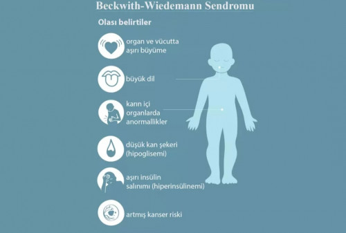 Beckwith-Wiedemann Sendromu 