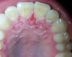 Oral mukoza: Termal yanıklar