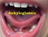 Ankyloglossia