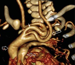 Arteryel "tortuosity" sendromu